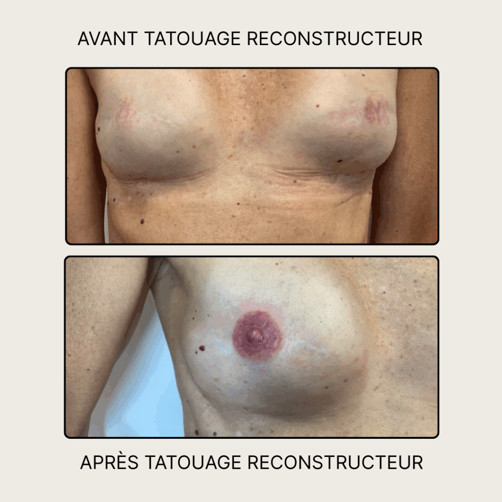 avant / après tatouage reconstructeur