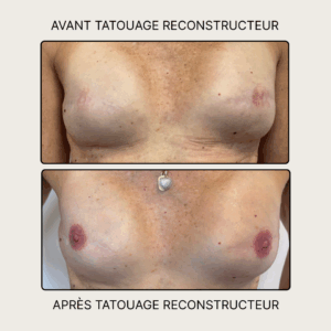 Avant / après tatouage de reconstruction mammaire