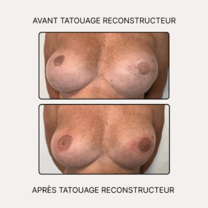 AVANT TATOUAGE RECONSTRUCTEUR (4)