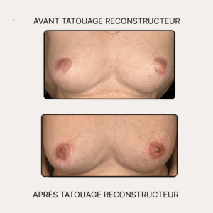 Tatouage reconstructeur aréoles mammaires Anita