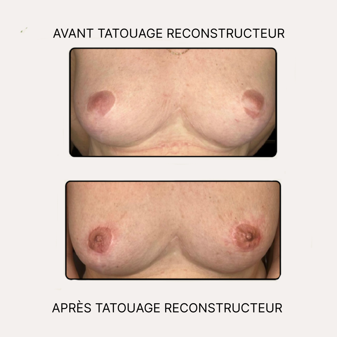 Tatouage reconstructeur aréoles mammaires Anita